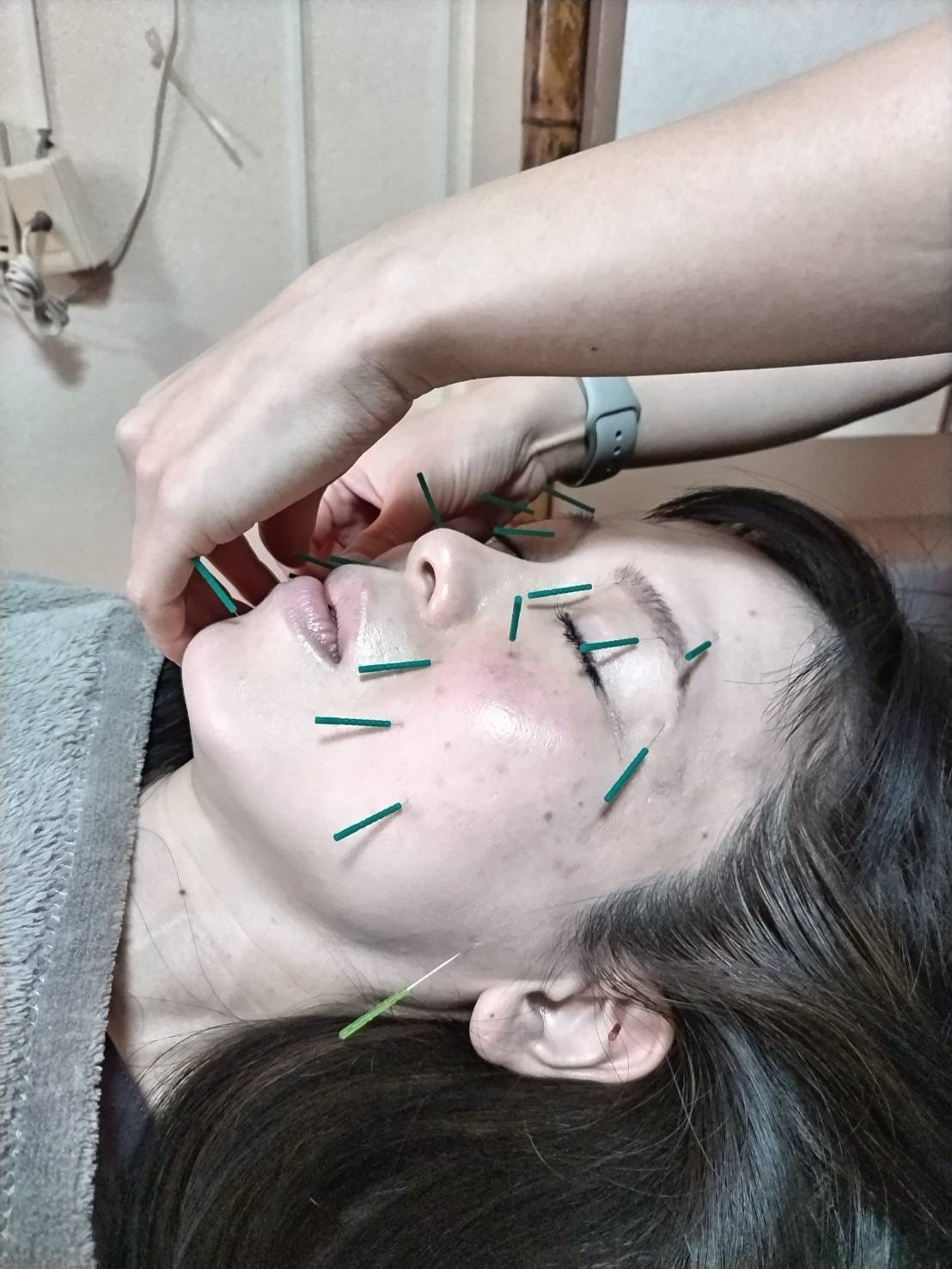 ファミール産院ふなばし　附属鍼灸治療院 Famille Wellness and Acupuncture (Funabashi) 美容鍼灸プレミアム(Facial acupuncture , Premium)のメニュー画像
