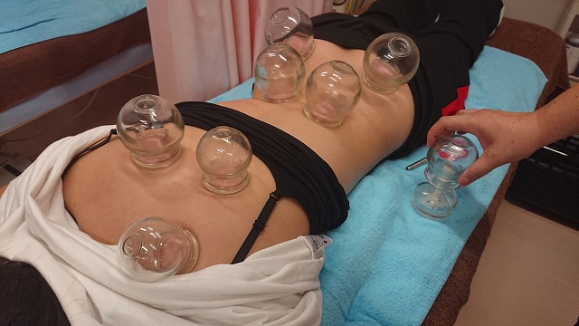 國安鍼灸整骨院　中野院 吸玉（カッピング）のメニュー画像