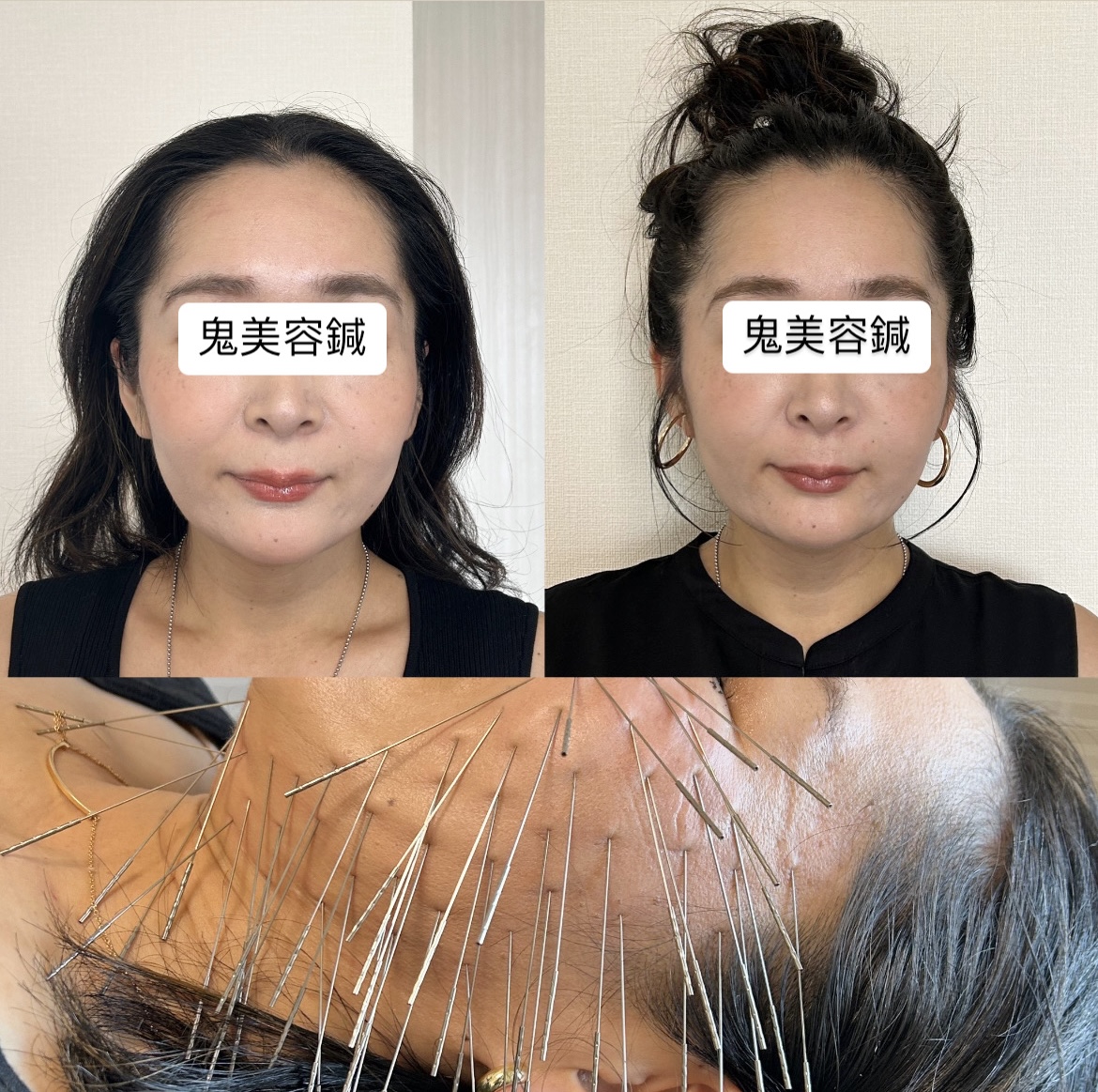 鍼処SHIRAKAWAなごや院千種【ルート治療専門院】 鬼美容鍼のメニュー画像