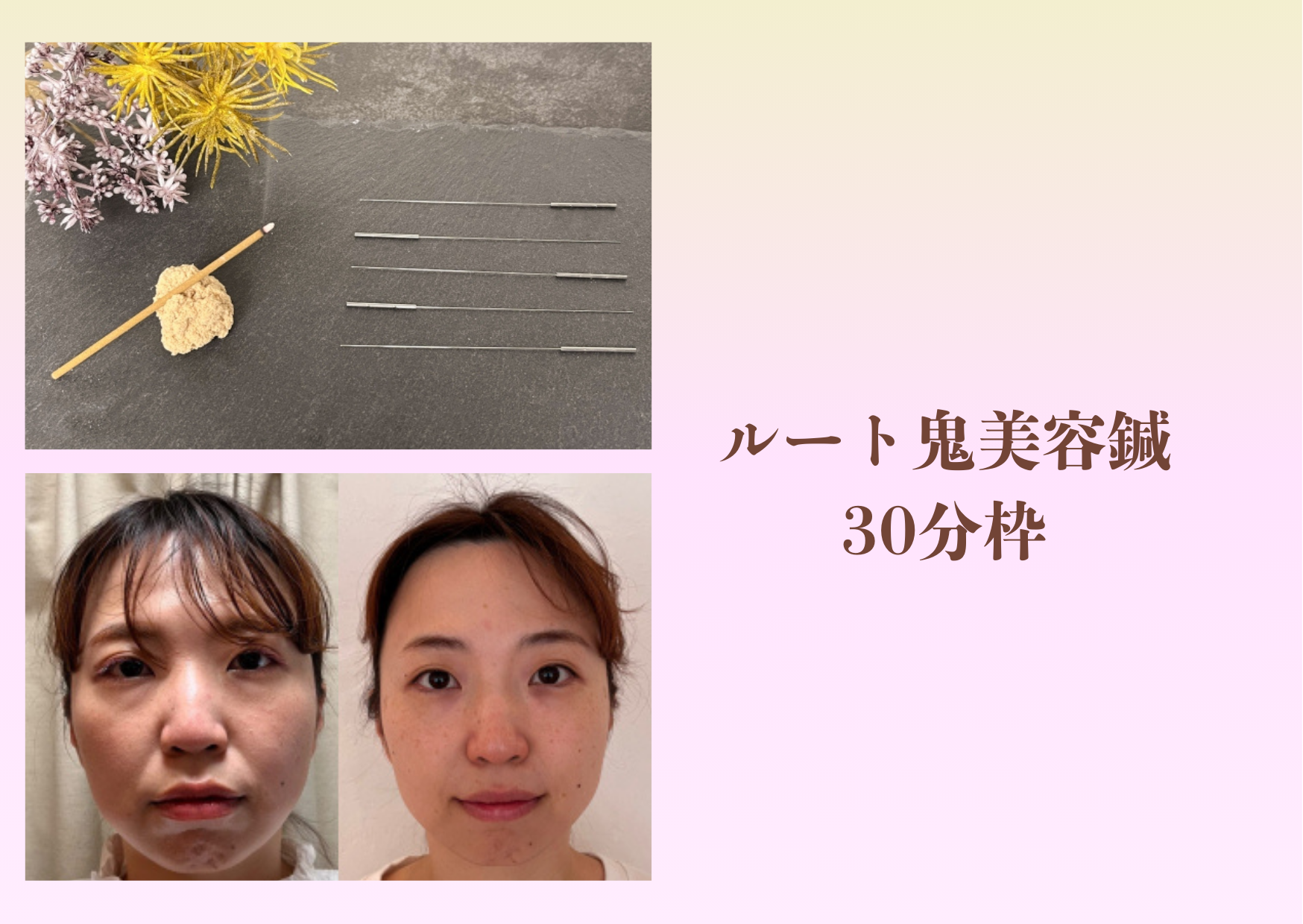 ゆり鍼灸院 ★ルート鬼美容鍼・30分枠のメニュー画像