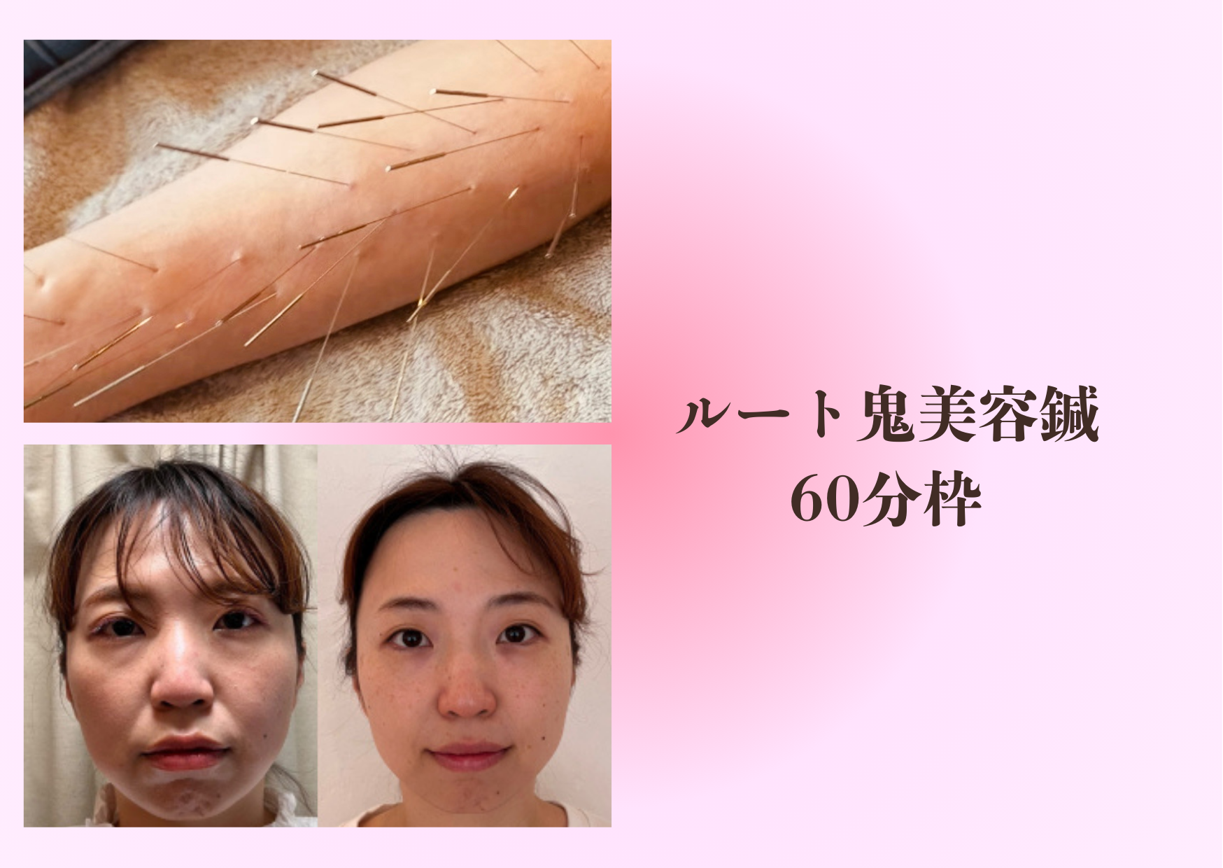 ゆり鍼灸院 ルート鬼美容鍼・60分枠（ロング）キャンペーン中のメニュー画像