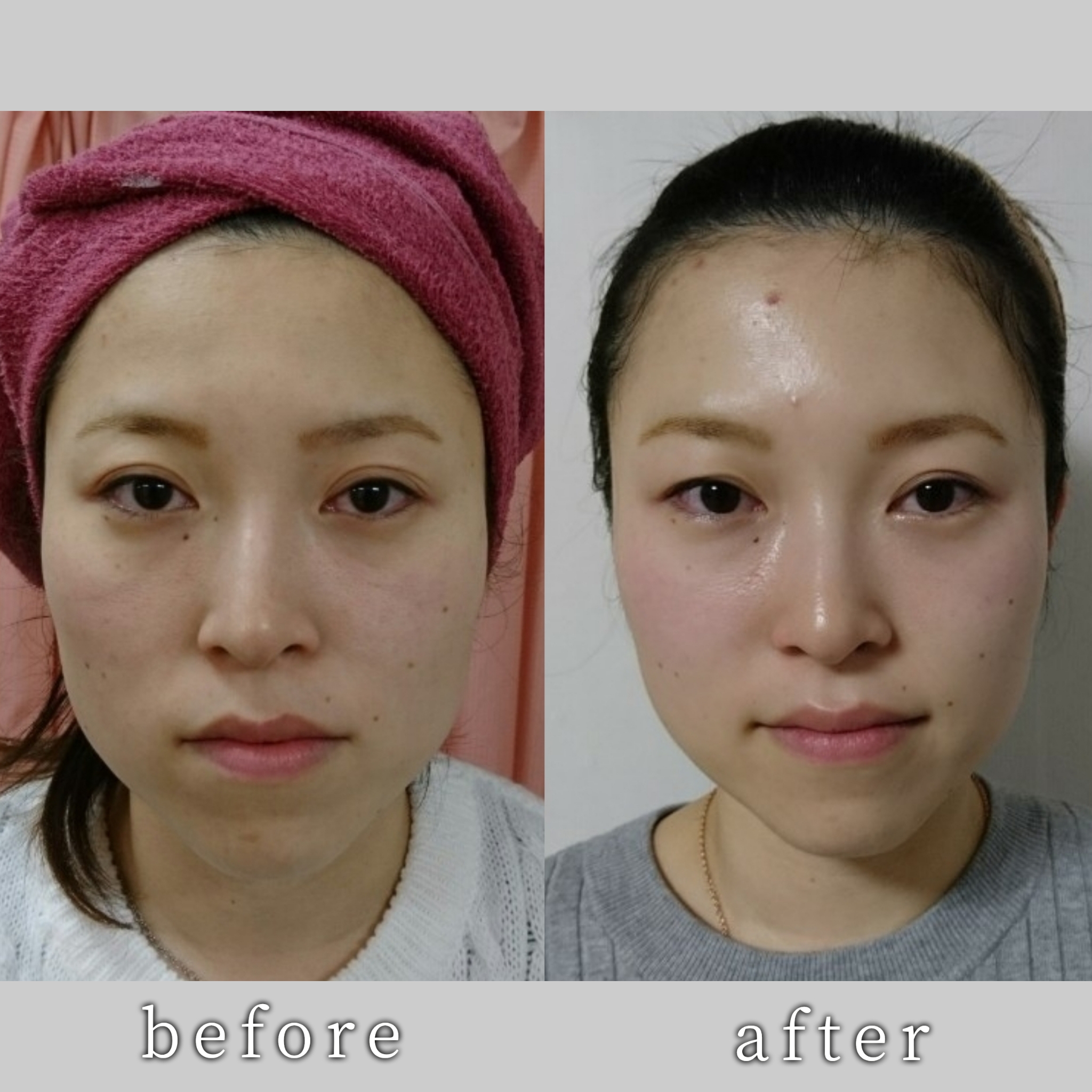 Total Care Sora スキンケア鍼プラチナ【新規限定価格】のメニュー画像