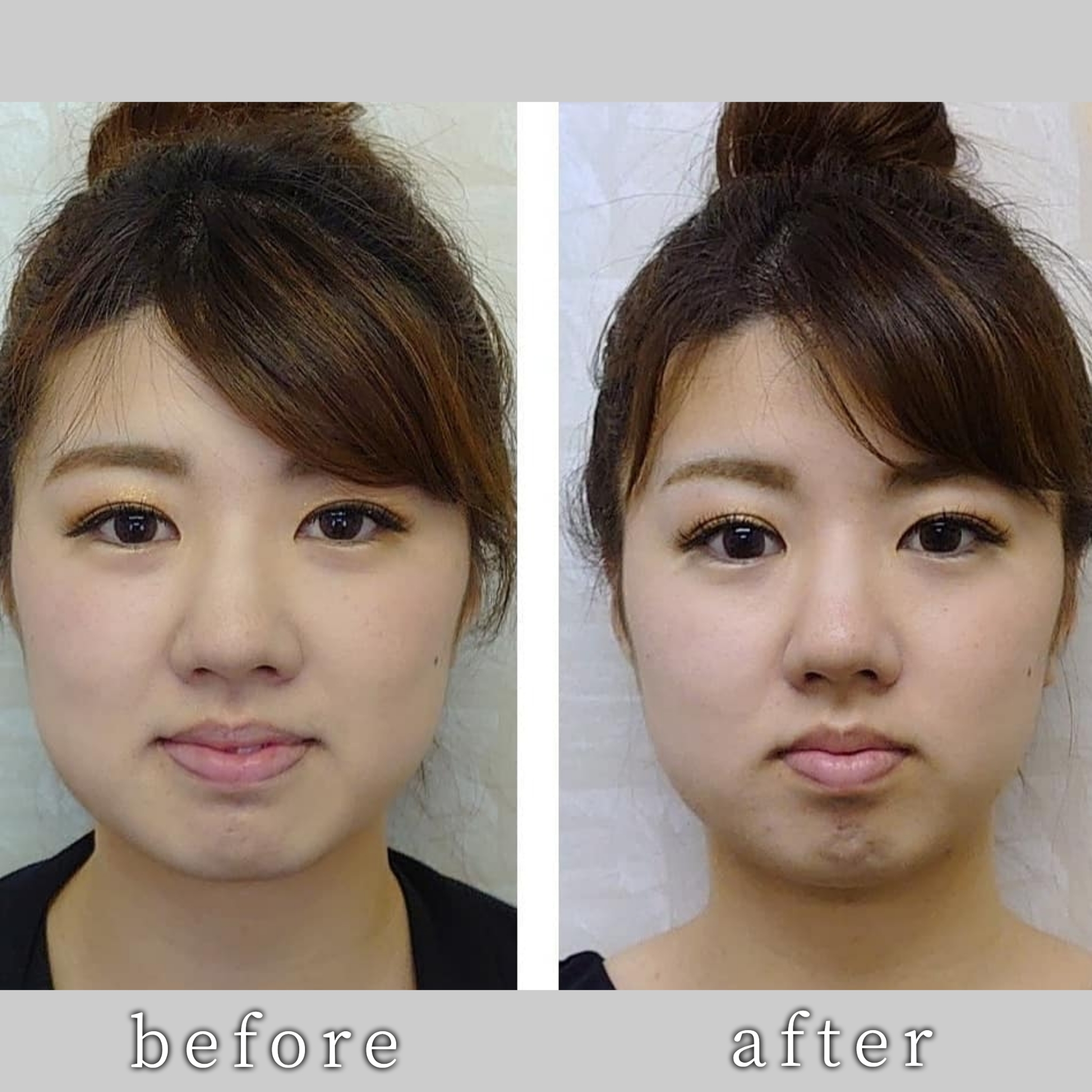 Total Care Sora 小顔鍼ゴールド【しんきゅうコンパス限定新規価格】のメニュー画像