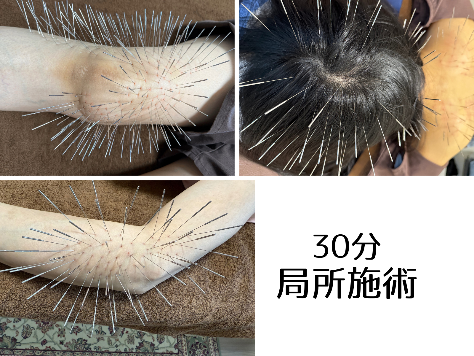 リーブル針灸院 南町田ルート治療 ルート治療　３０分【局所治療】のメニュー画像