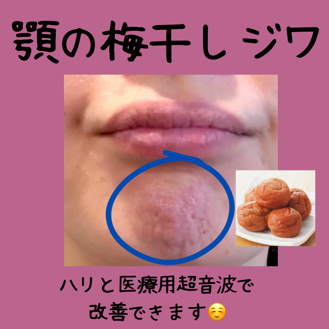 薄毛鍼　本気で向き合う　いくほ治療院 顎シワ治療のメニュー画像
