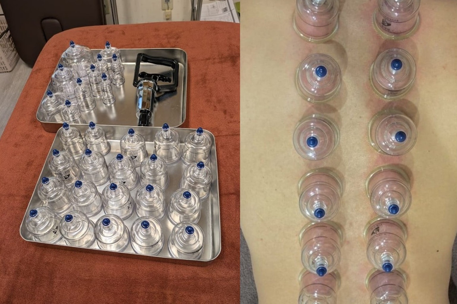 Owl治療室 カッピング（吸い玉）のメニュー画像