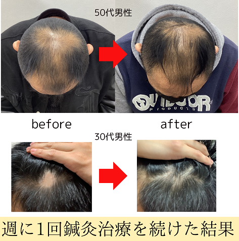 まえだ鍼灸院 薄毛治療(はじめての方)のメニュー画像