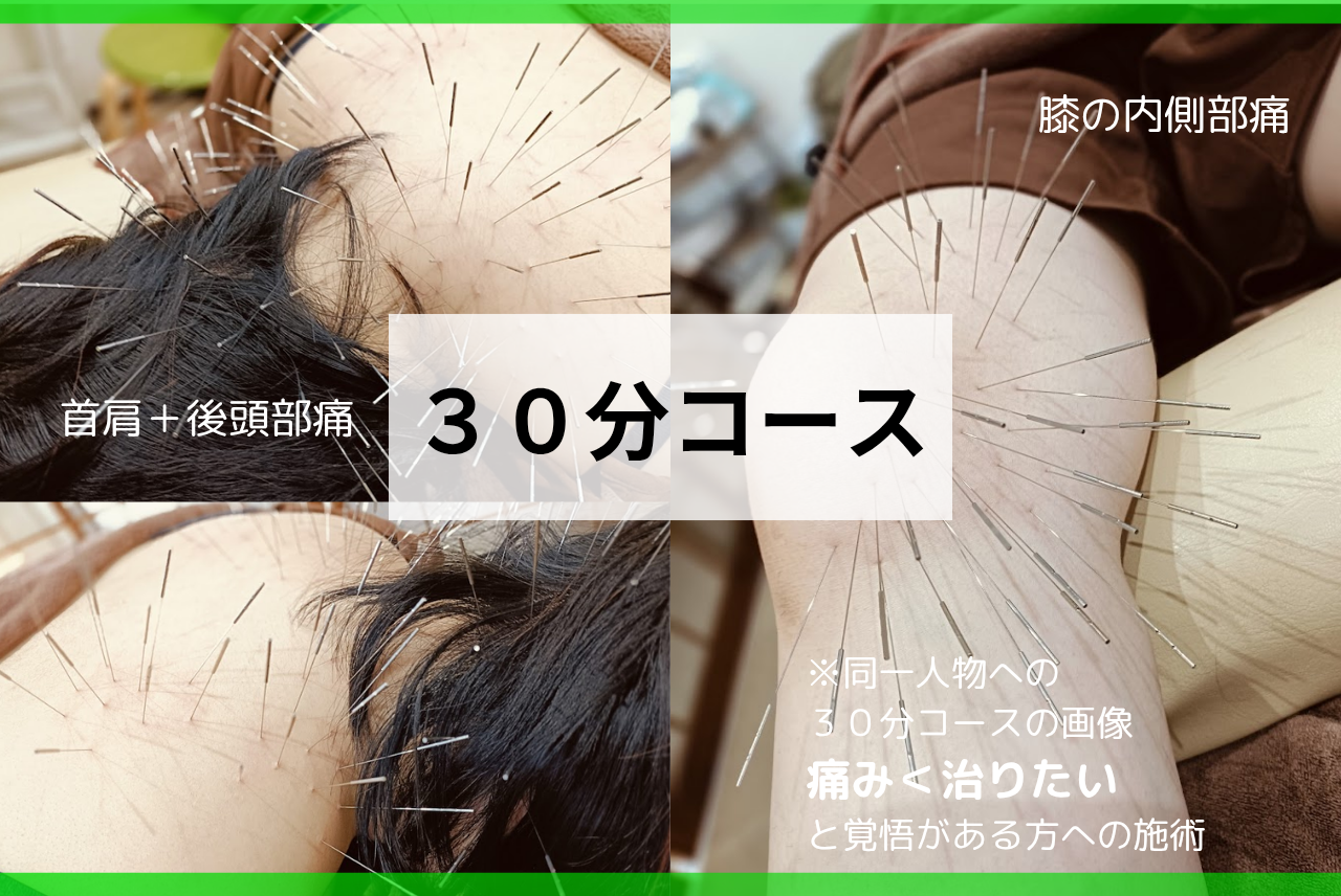 はり処もり　(ルート鍼専門院) 30分コース　短時間でガツンと効かせるショートコースのメニュー画像
