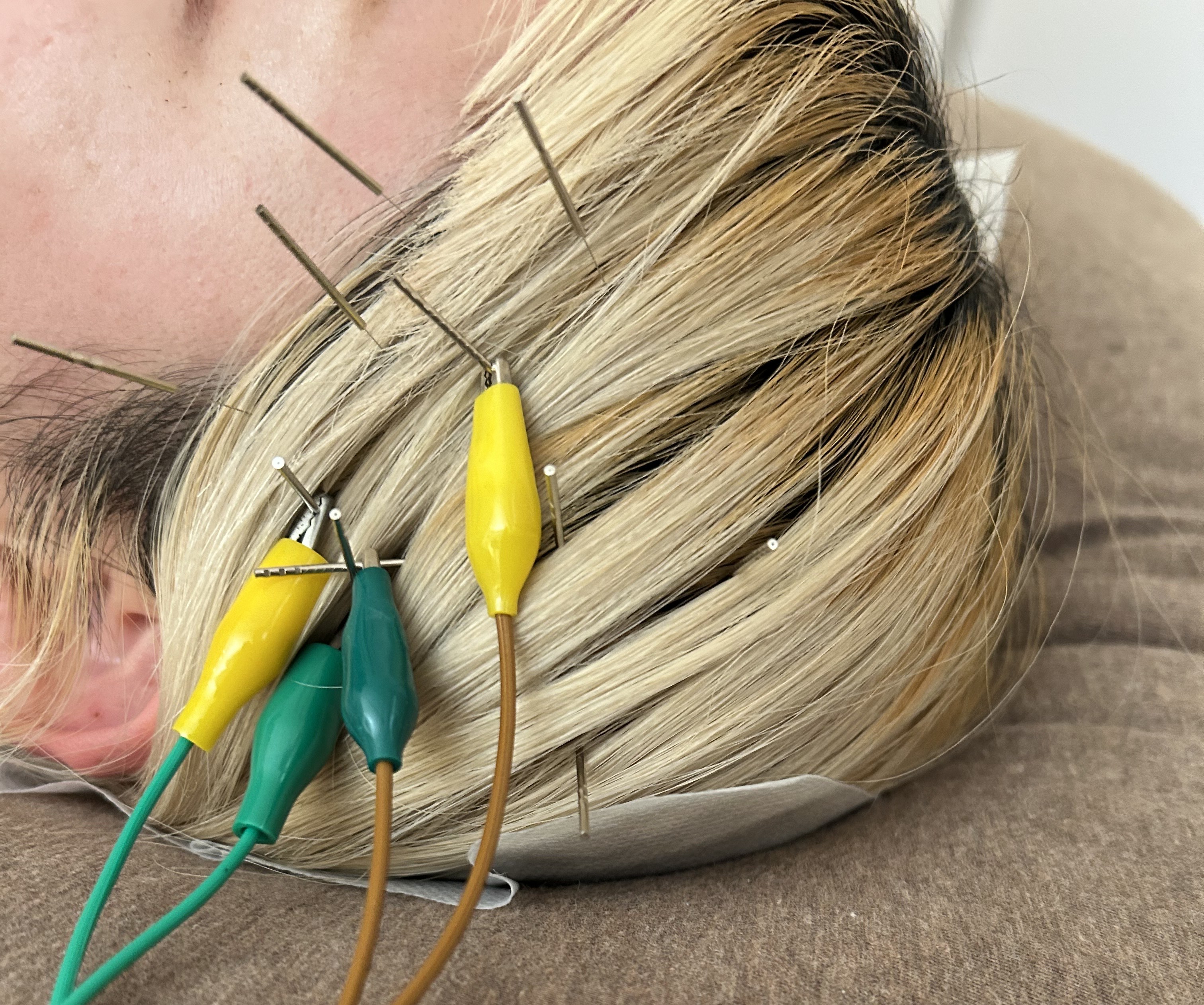 鍼灸院 侑秀 NIIGATA 電気鍼のメニュー画像