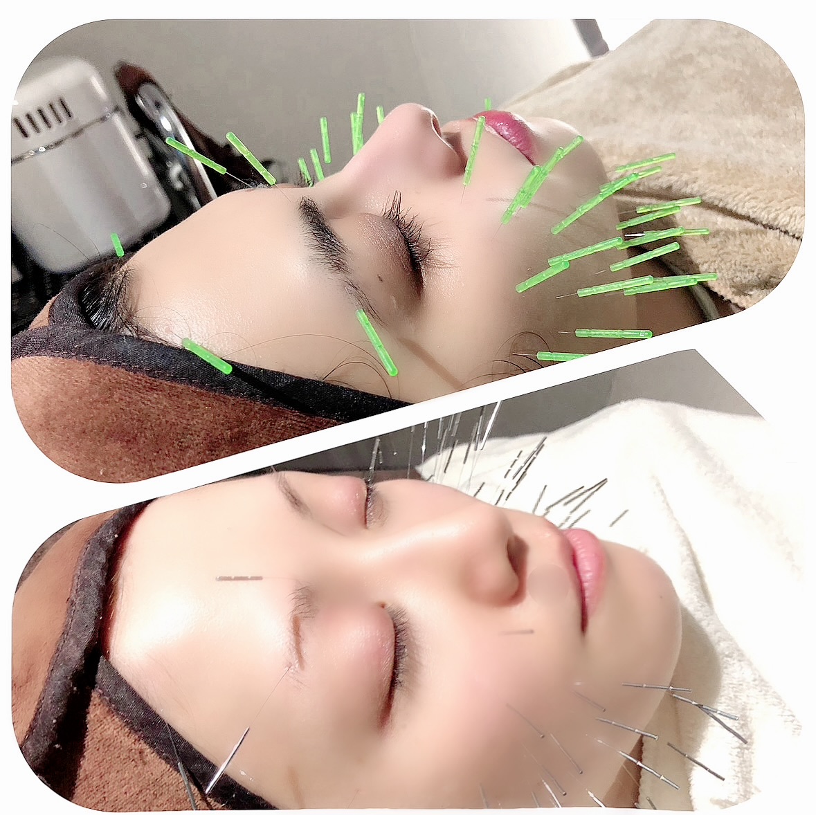 セントラル鍼灸院Re:laxy 眼瞼痙攣鍼/17600が２回目からもお得のメニュー画像