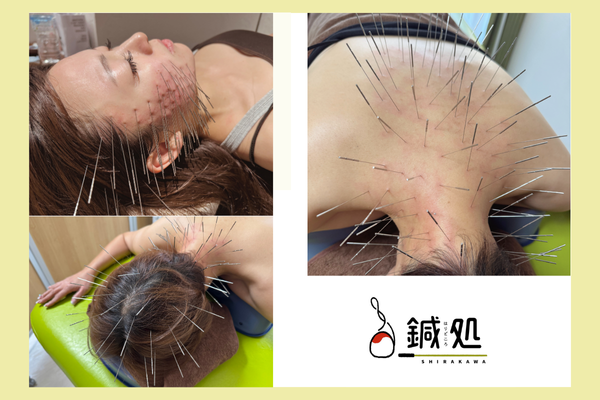 鍼処SHIRAKAWA小倉院 短時間で不調の核心に　　　　　　　　　　　【ピンポイント集中ルート治療】のメニュー画像