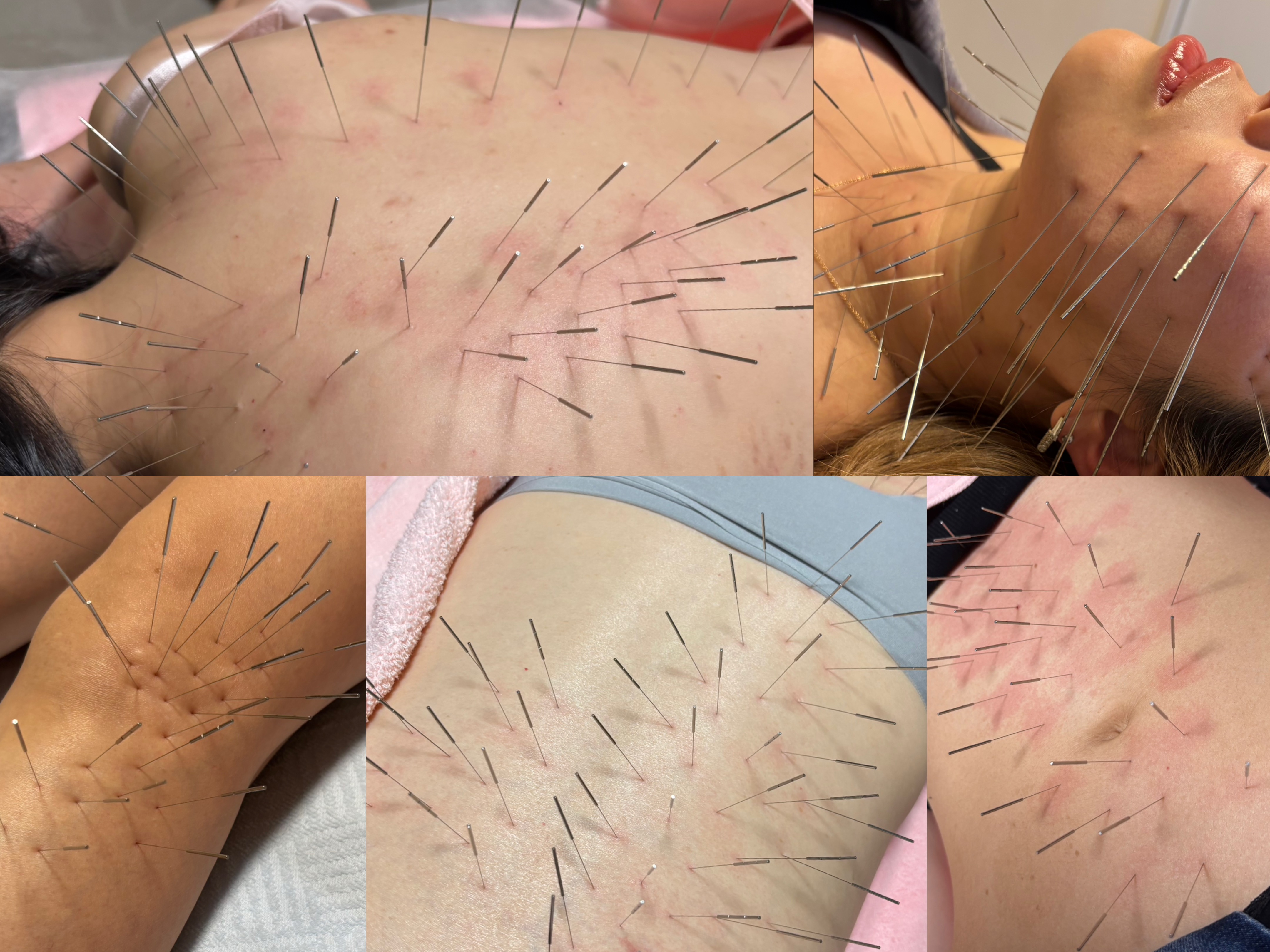 鍼処 ｕ.【ルート治療専門】 【ルート治療】美容鍼も可⭐︎ほぼ全身可⭐︎スタンダードコースのメニュー画像