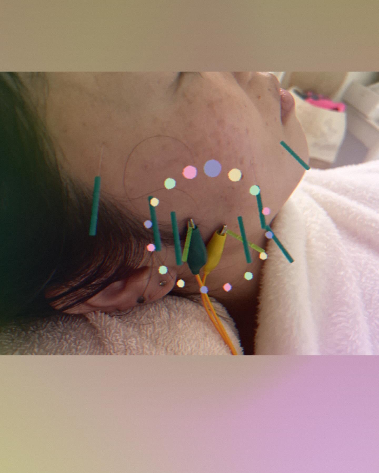 女性専用美容鍼灸　采花鍼灸院 美顔鍼パルスコースのメニュー画像