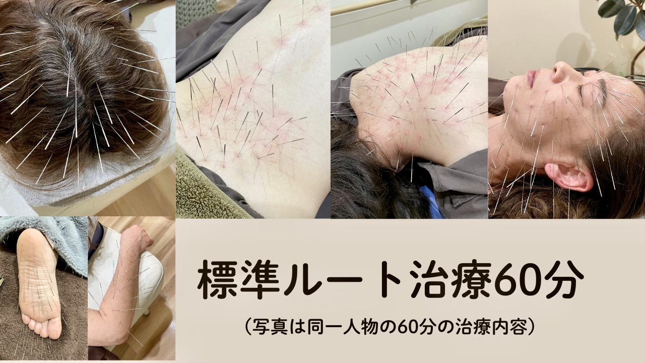 鍼灸院ひかり（ルート鍼専門・岐阜院） 標準ルート治療６０分のメニュー画像