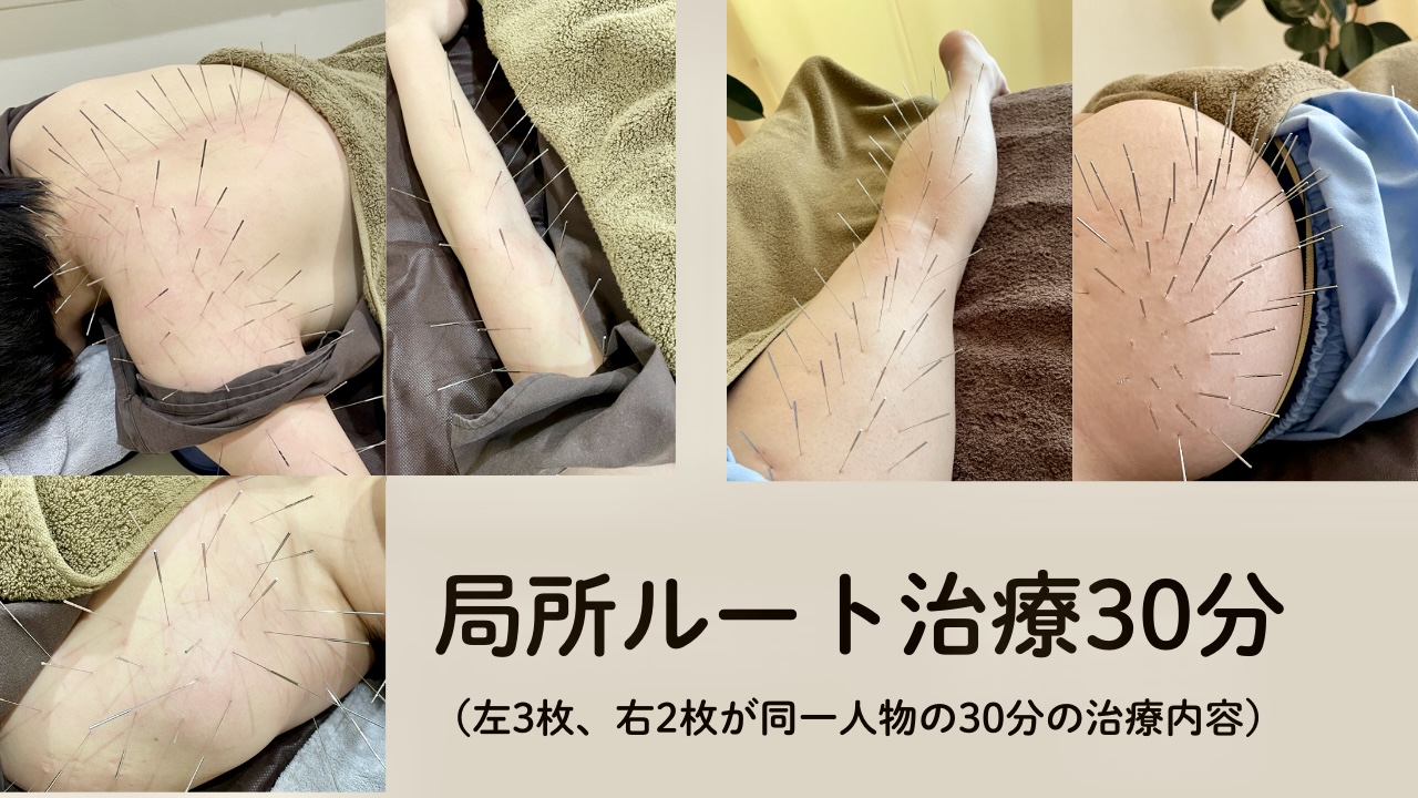 鍼灸院ひかり（ルート鍼専門・岐阜院） 局所ルート治療３０分のメニュー画像