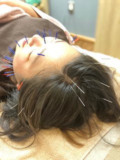 はりきゅうサロン結【更年期・妊活・自律神経ケア専門】 リフトアップ美容鍼＋全身鍼灸のメニュー画像