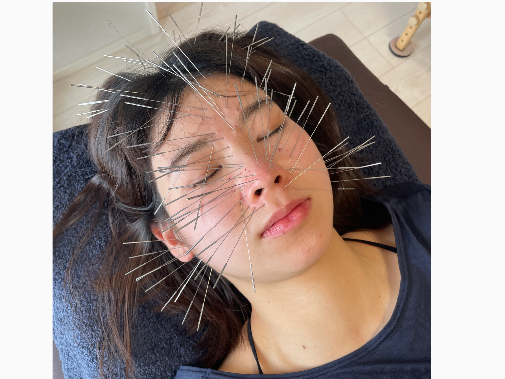 からだリメイク整骨院 ルート鬼美容鍼（30分~40分）のメニュー画像