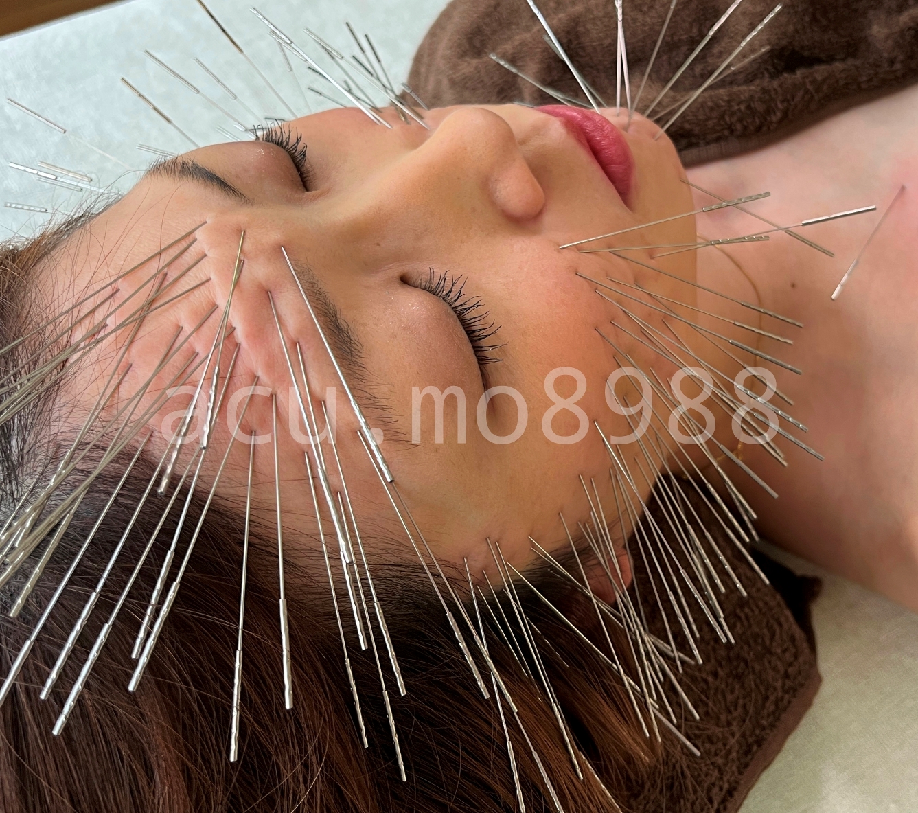 ルート鍼治療【土佐】もりさわ治療院 【初回限定】ルート鬼美容鍼60（標準）のメニュー画像