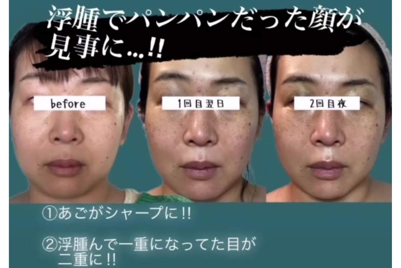 はり処もり　(ルート鍼専門院) 鬼美容鍼(顔のみ)のメニュー画像