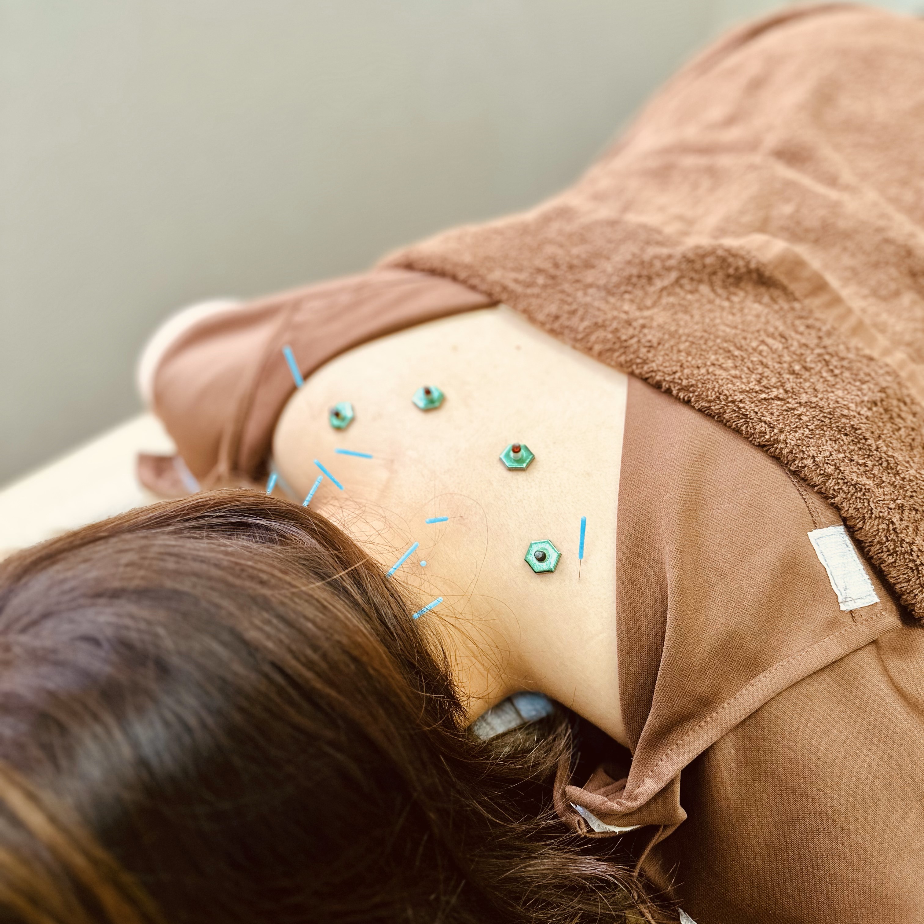 志田鍼灸接骨院 鍼灸　初回体験のメニュー画像