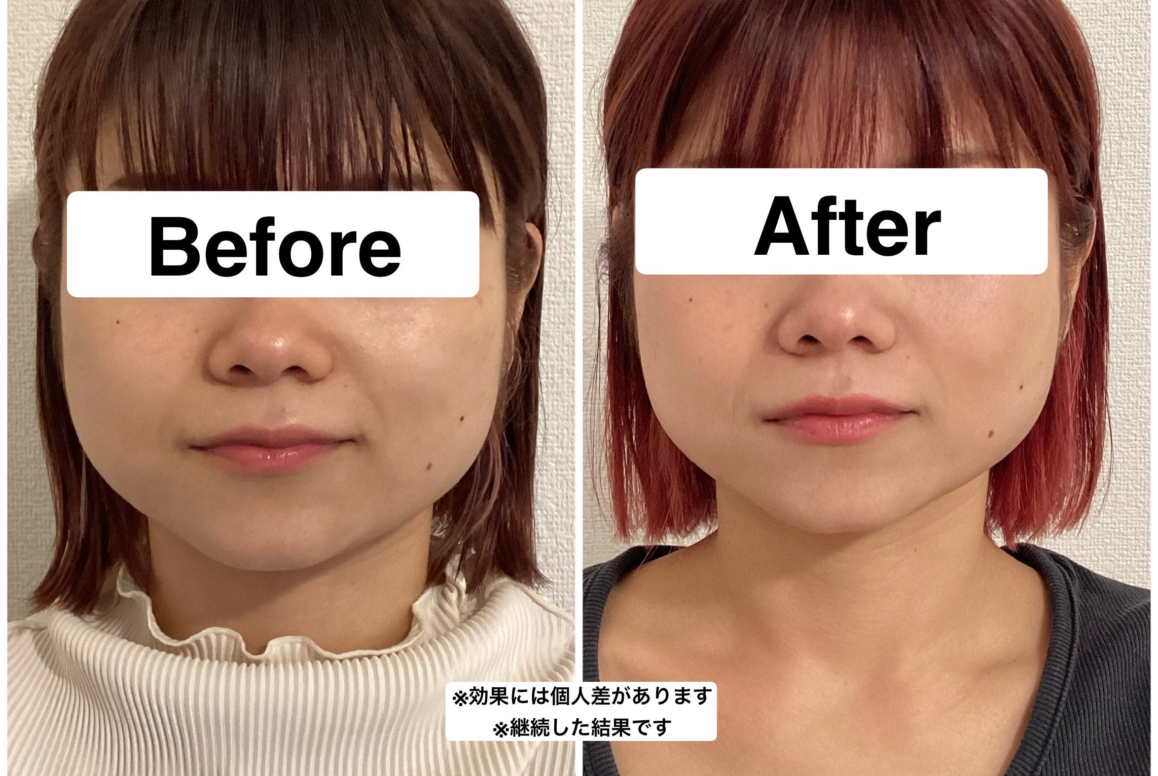 green鍼灸整体院(美容鍼と整体の専門院) 【初回特別価格】人気No1エラ撃退美容鍼モニター募集！　限定３名！通常￥15000→初回￥2980のメニュー画像