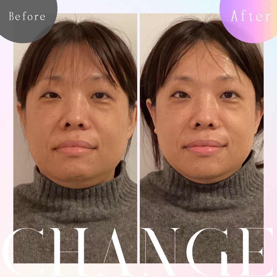 solua鍼灸整骨院（あしなが整骨院長尾院内） 【美容鍼灸】リフトアップ小顔鍼灸☆フェイスライン改善！（ヘッド・ネックマッサージ付き）¥7980のメニュー画像