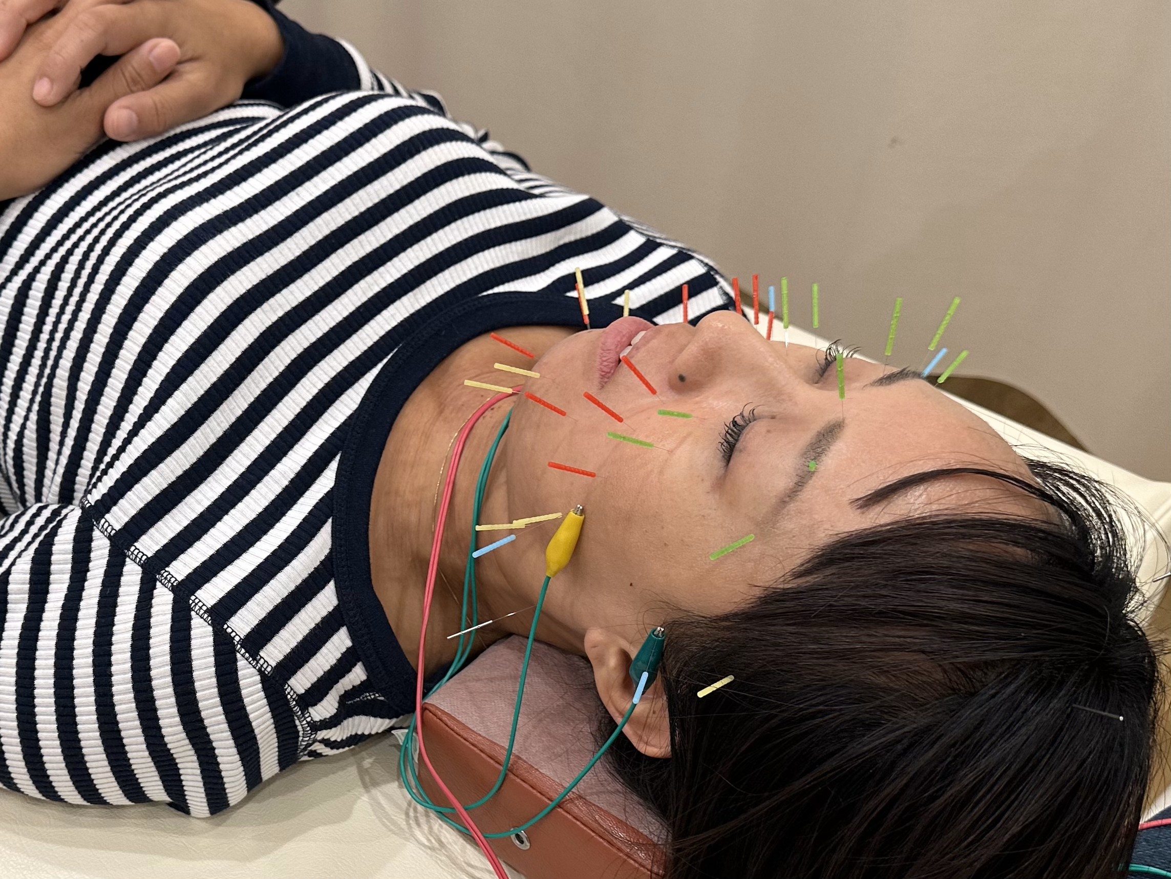 行徳エール鍼灸整骨院 電気美容鍼のメニュー画像