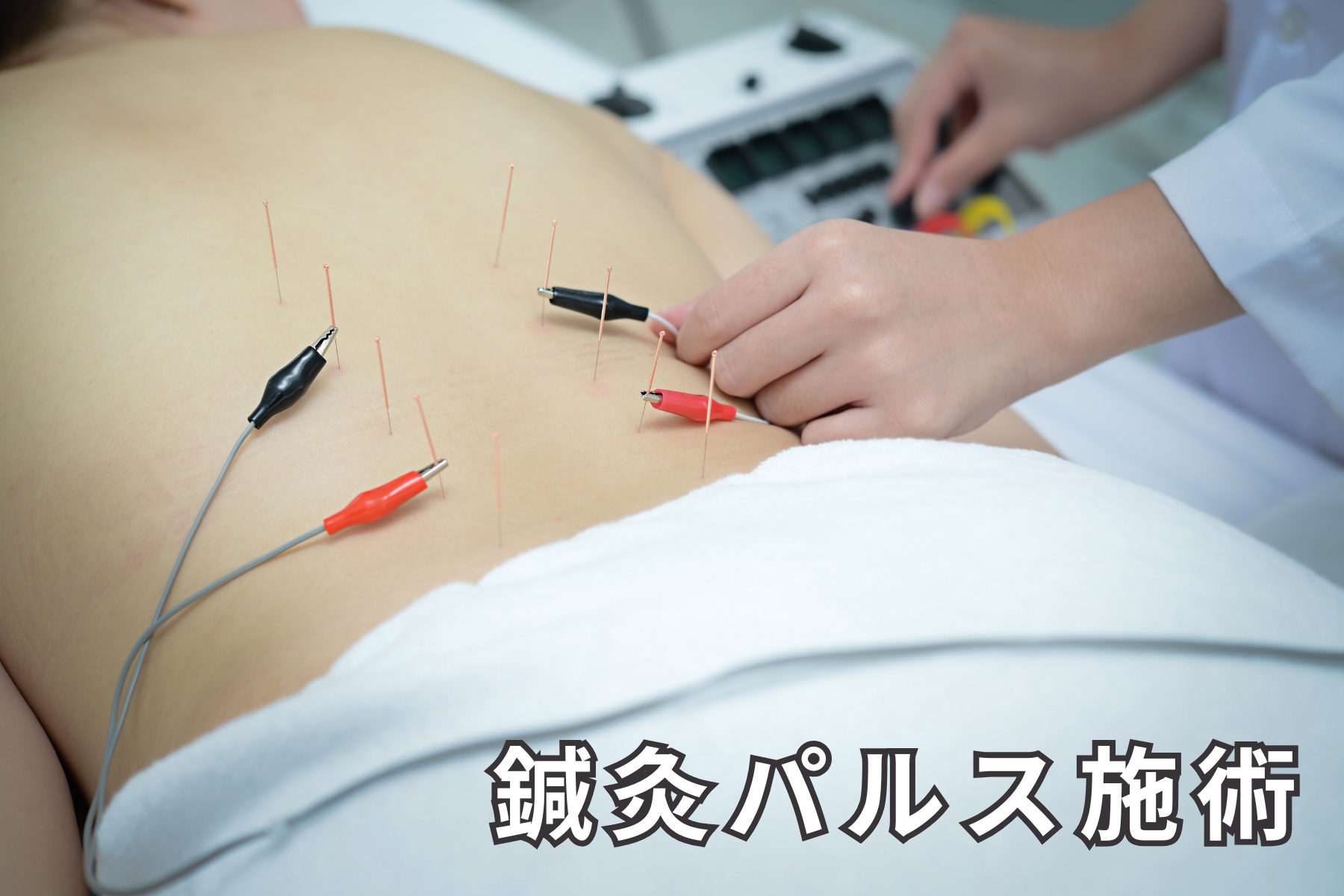 沖縄県那覇市首里スマイル鍼灸整骨院　本院 鍼灸施術パルス療法のメニュー画像