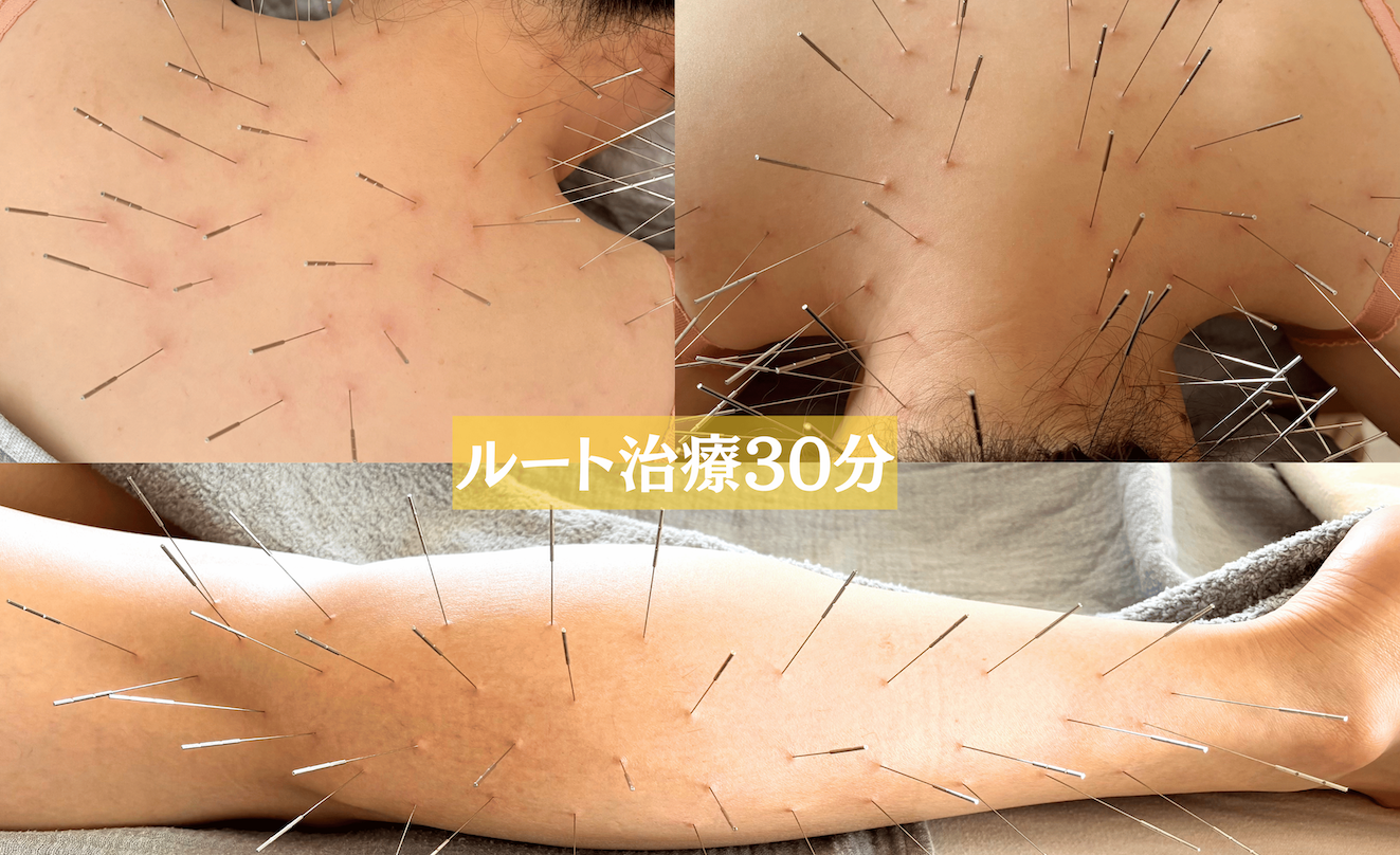 鍼処suzunone ルート治療30分　〜ショート集中コース〜のメニュー画像