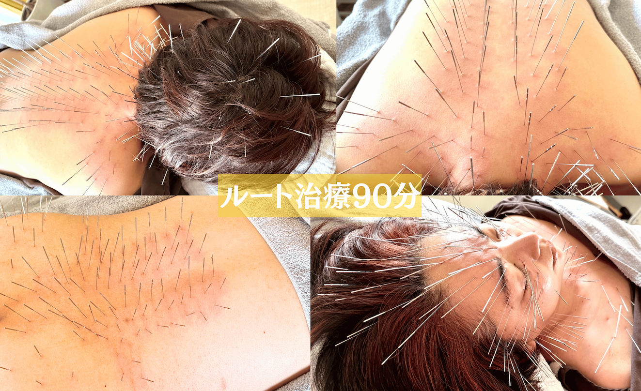 鍼処suzunone ルート治療90分　〜プレミアムコース〜のメニュー画像