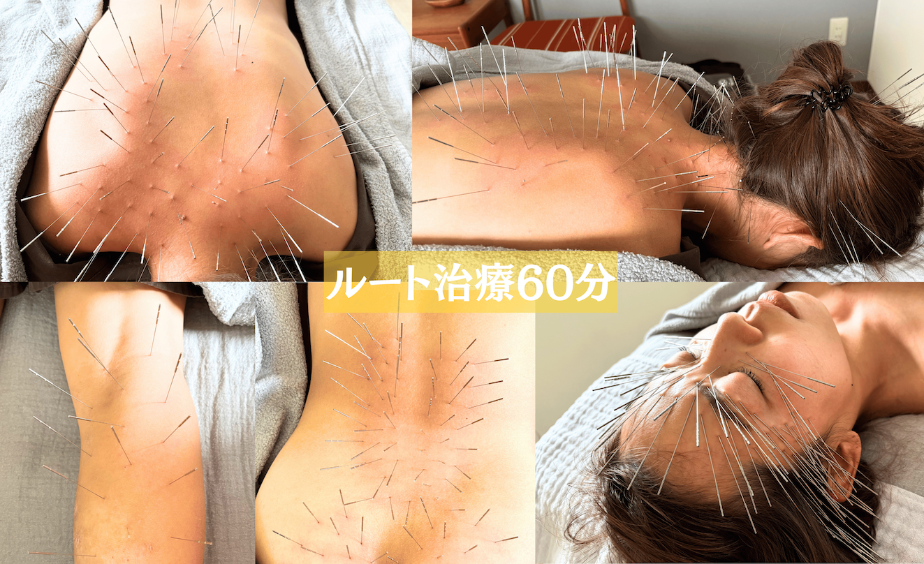 鍼処suzunone ルート治療60分　〜スタンダードコース〜のメニュー画像