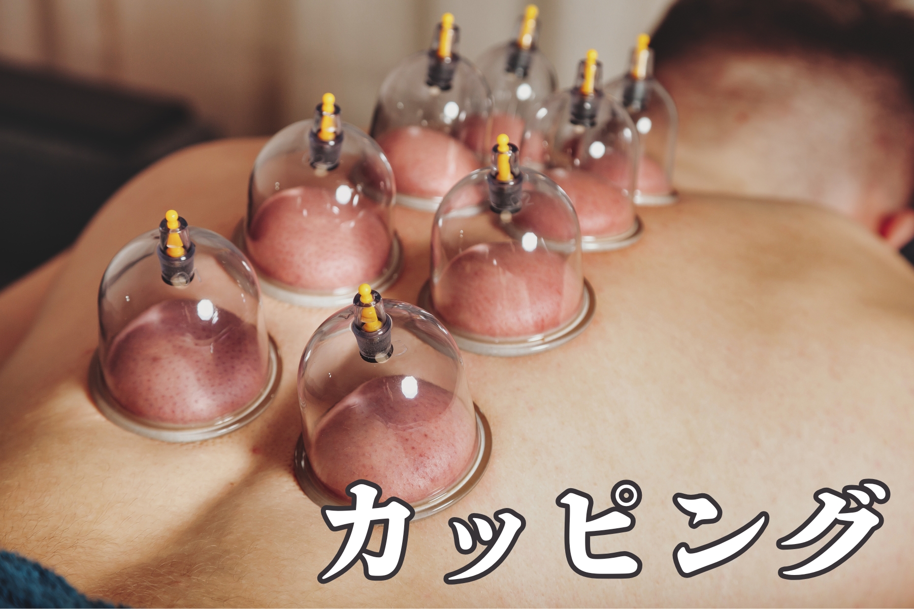 沖縄県那覇市首里スマイル鍼灸整骨院 本院 アップグレードコース【カッピング】カッピングの回数や個数が増えることにより免疫力や体のコリがほぐれていきます。。のメニュー画像
