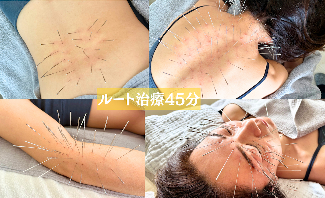 鍼処suzunone ルート治療45分　〜コンパクトコース〜のメニュー画像