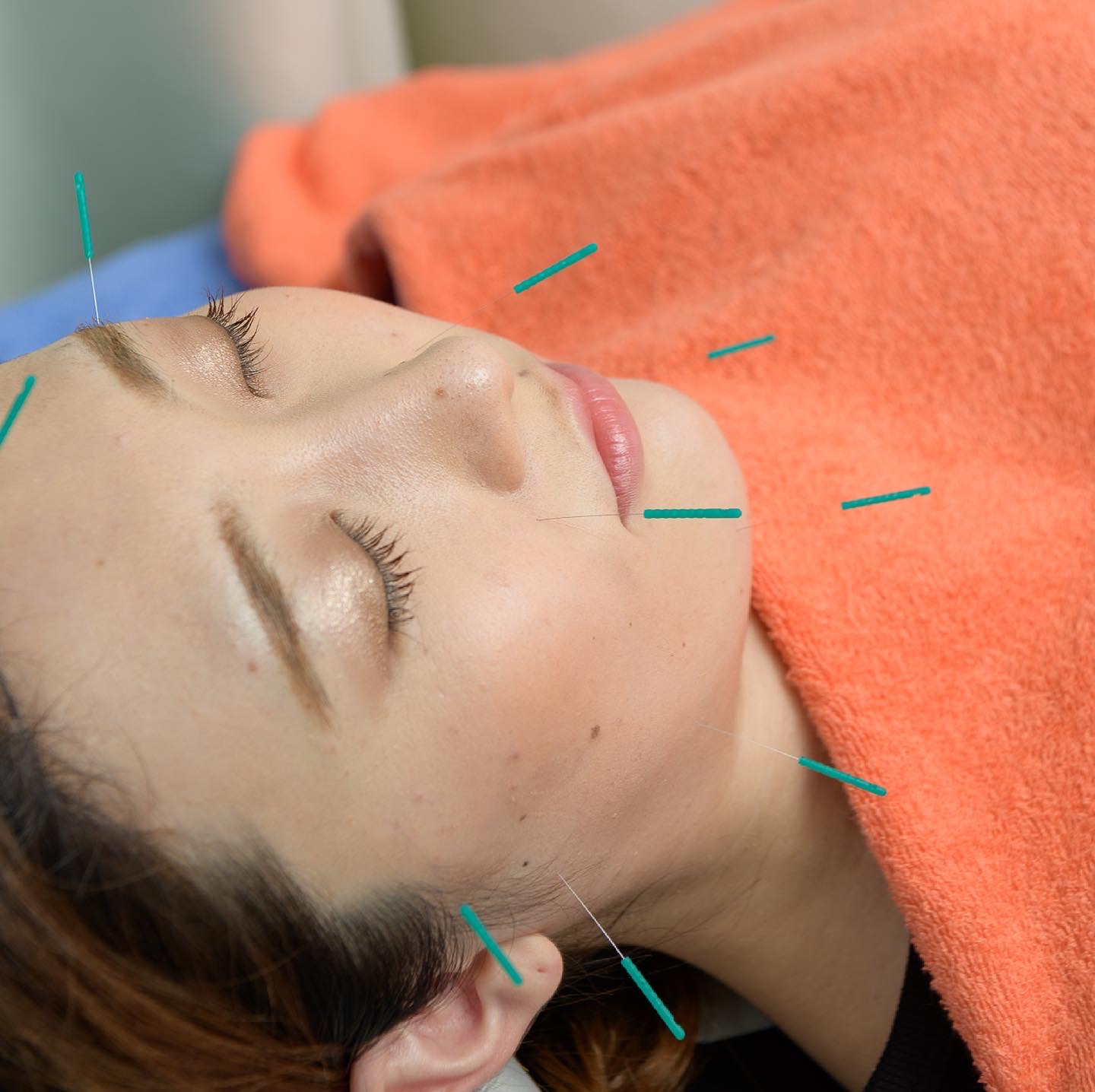 ムラタ鍼灸治療室 初回限定！美容鍼＋インディバ＋マイクロカレントパックのメニュー画像