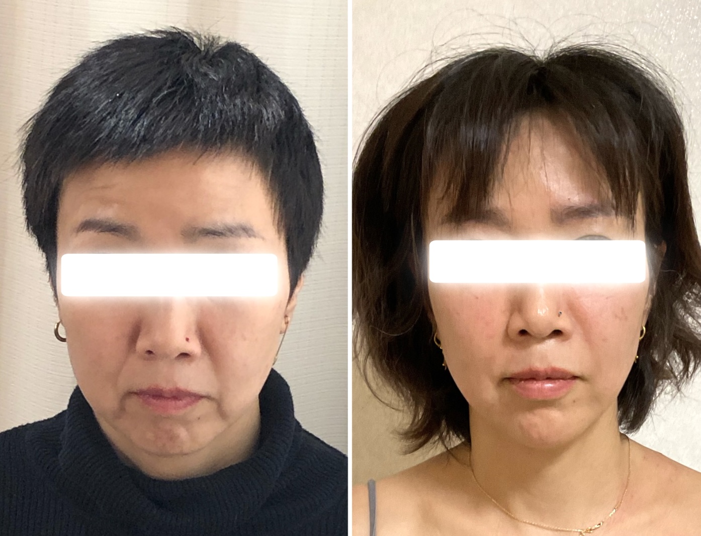 鍼と灸サロンクレド【ルート治療院】●大治町本院 鬼美容鍼35分のメニュー画像