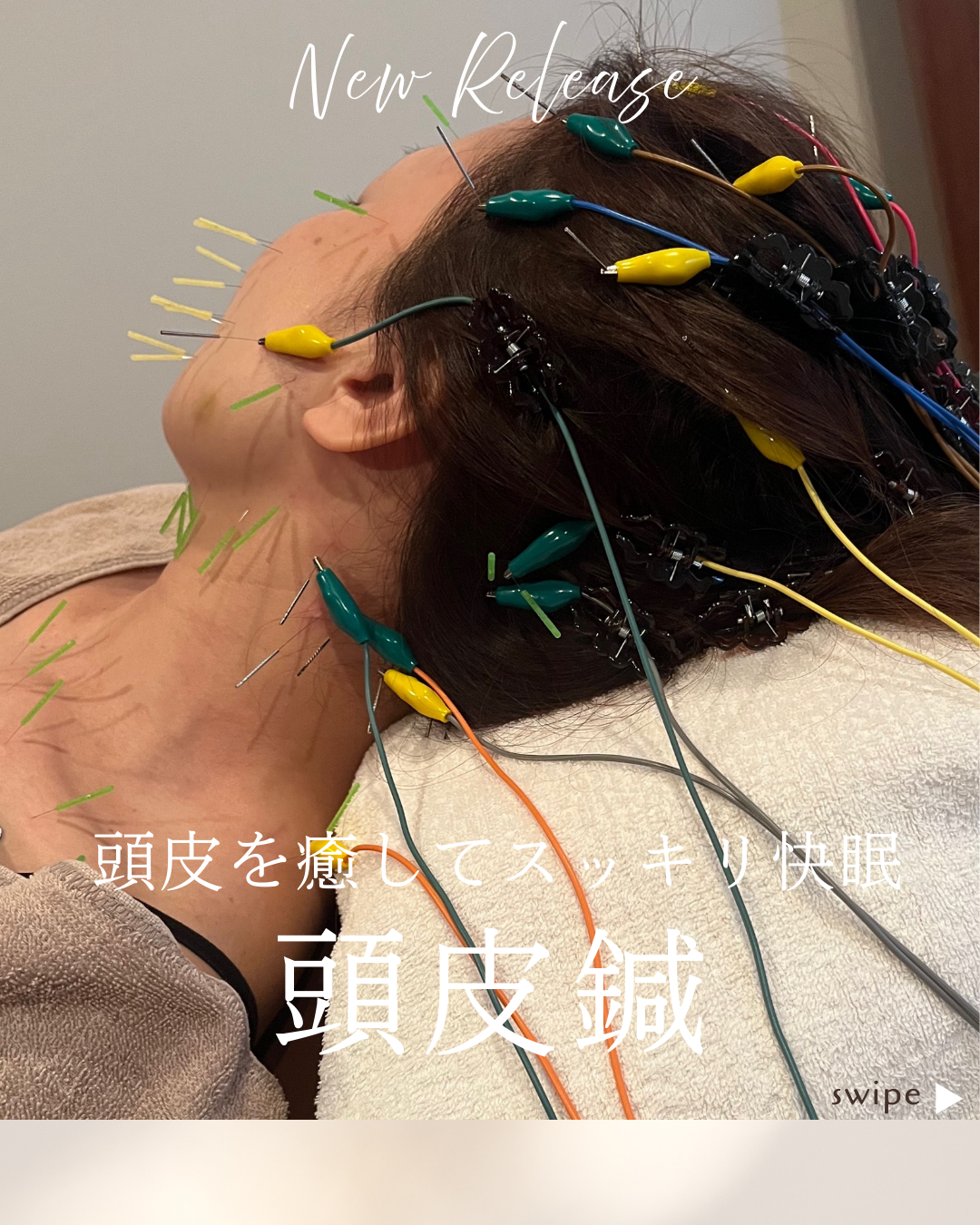 IZUMI 鍼灸院 (トライアル)頭皮鍼＋首デコルテ＋美容鍼のメニュー画像