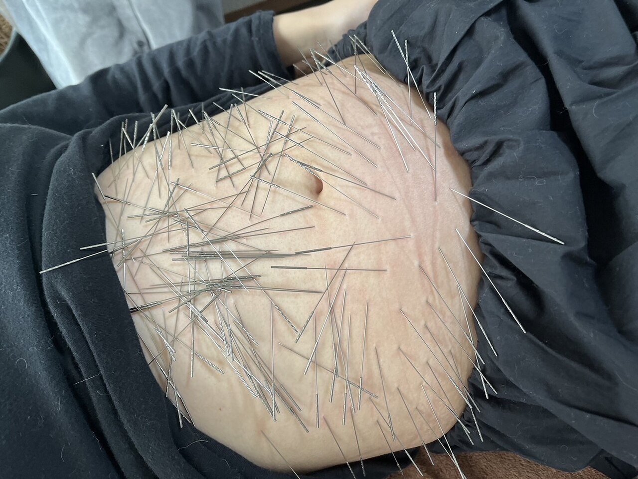 葵の葉鍼灸院 【妊活・産前産後特化】　ルート鍼施術　のメニュー画像