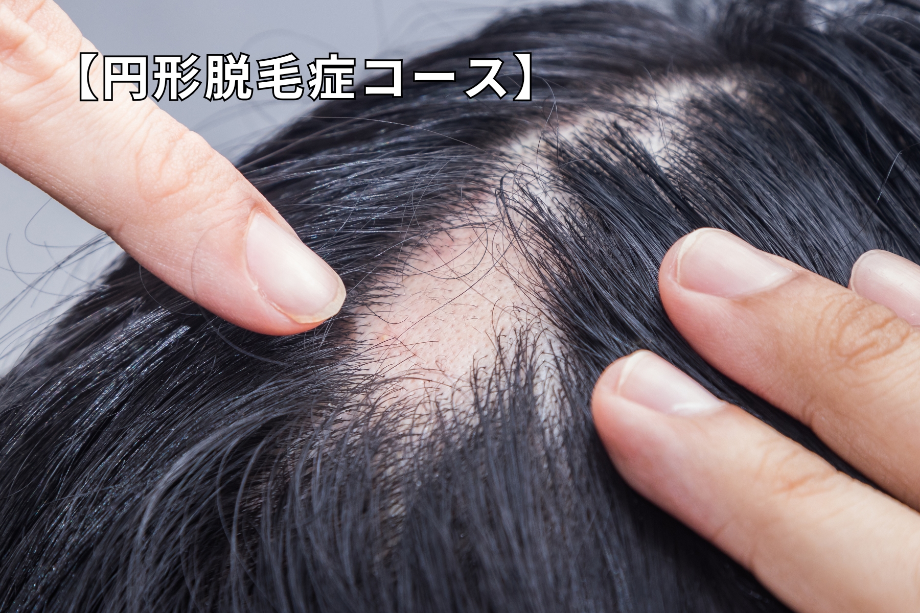 沖縄県那覇市首里スマイル鍼灸整骨院 本院 相談依頼急増中!円形脱毛症治療|実績ある国家資格者が施術する鍼灸治療。原因はストレスや環境の変化から始まる脱毛現象。リーズナブルに長期的に通院しやすい価格。のメニュー画像