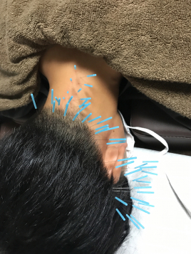 おざき鍼灸整骨院　美容鍼灸サロンOZAKI 【18時以降のご予約／初回】眼精疲労鍼灸のメニュー画像