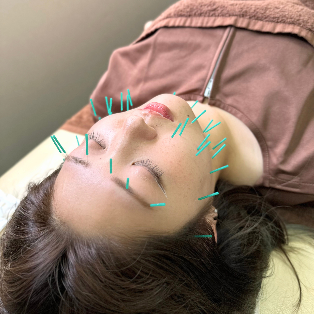 志田鍼灸接骨院 美容鍼　初回体験のメニュー画像