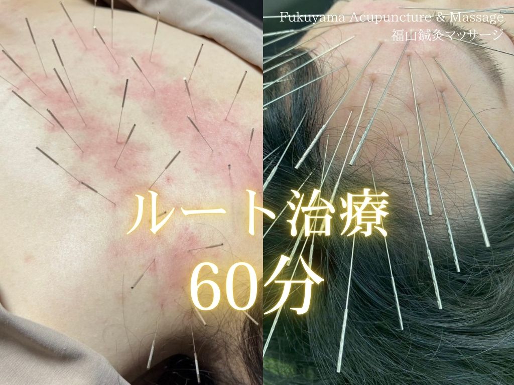 【ルート治療・鬼美容鍼】福山鍼灸マッサージ 【口コミお書きくださる方限定】ルート治療60分のメニュー画像