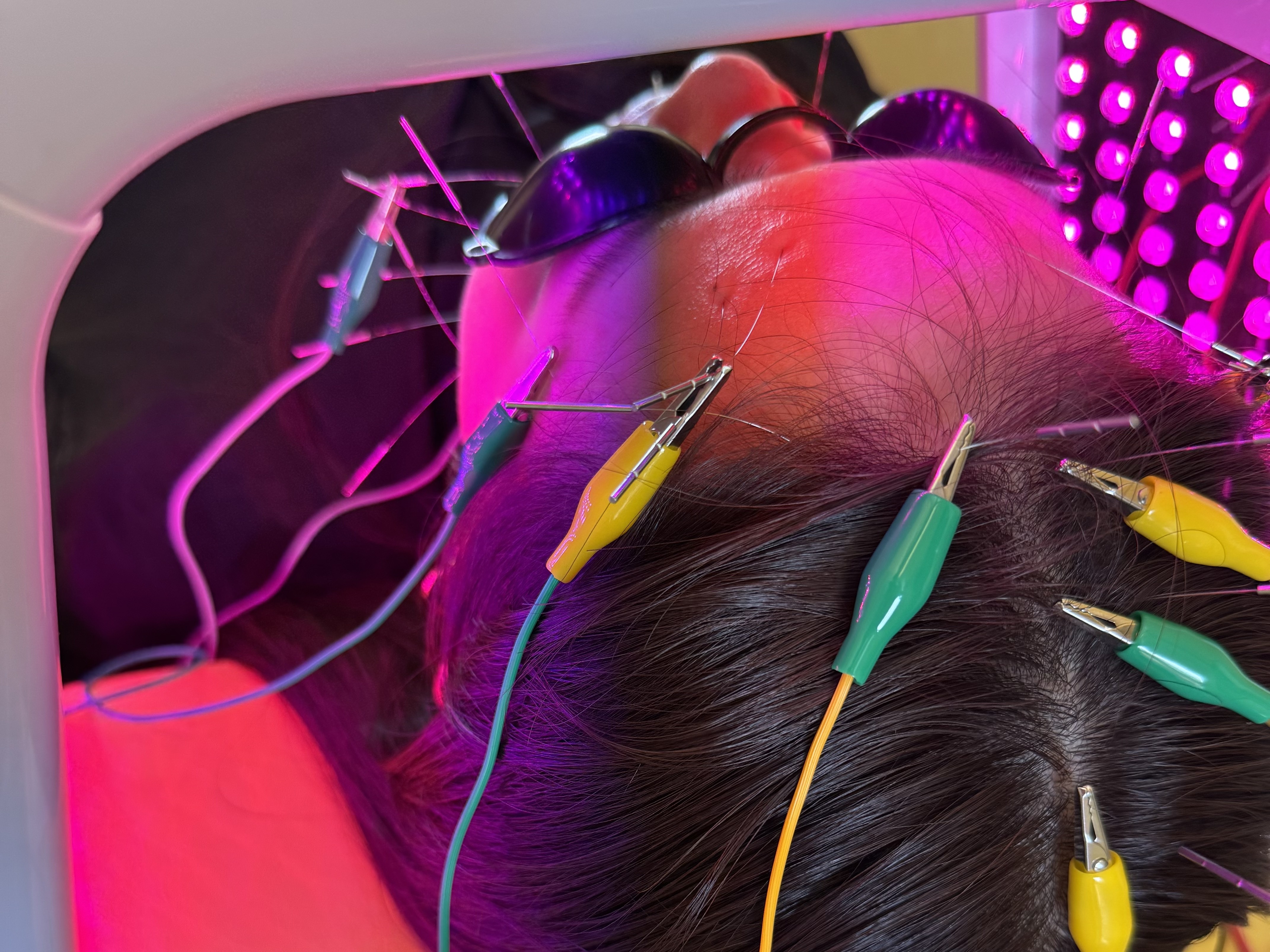 ゆめたか接骨院・鍼灸院大沢野院 60代以上の美容鍼｜エイジングケアと自然な美しさを引き出すやさしい刺激のメニュー画像