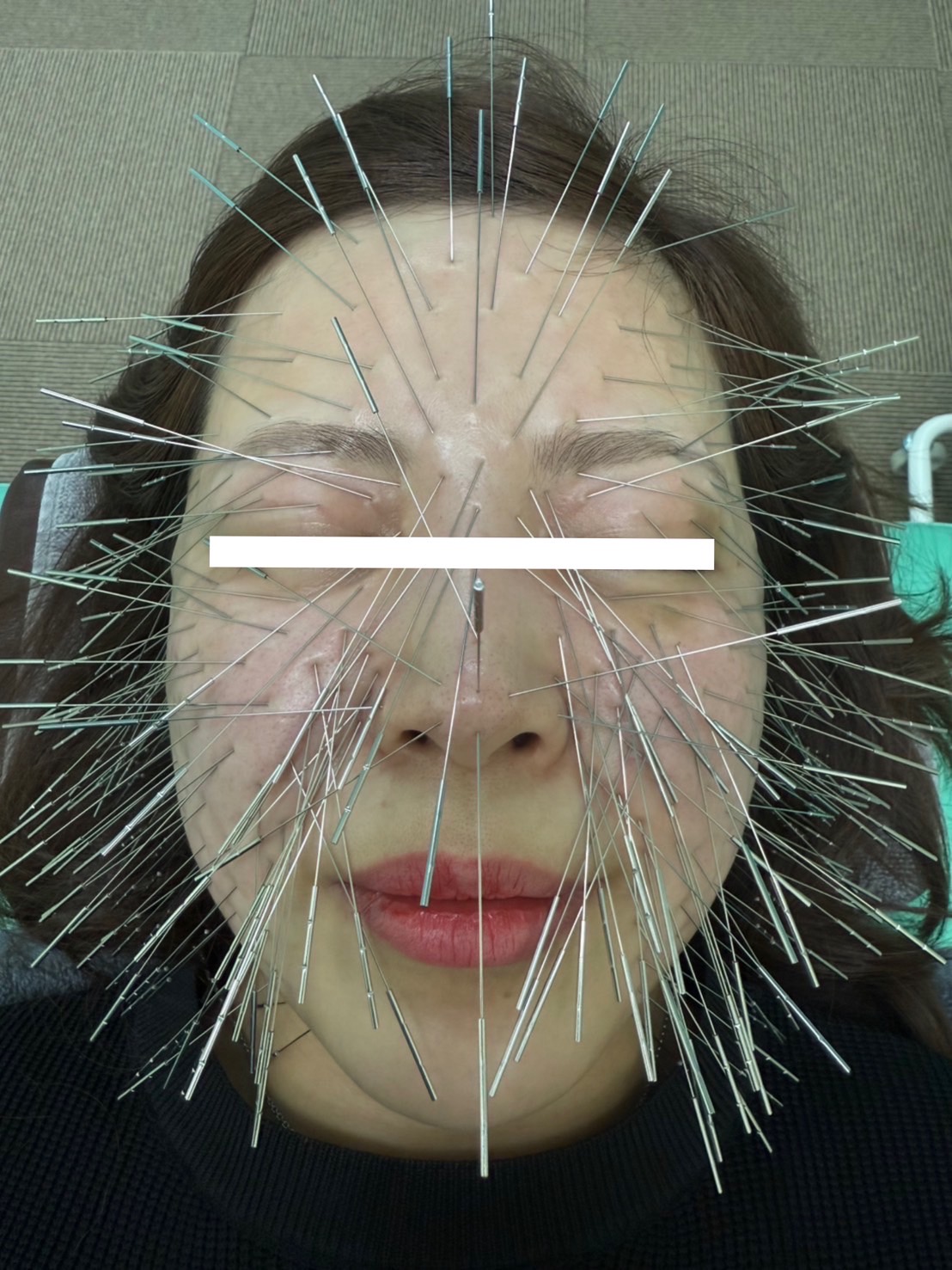 ルート治療福岡 鬼美容鍼30分【お悩み部位が多い方】のメニュー画像