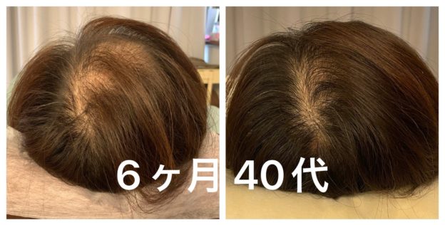 いいとこ鍼灸院 【産後ママさん】育毛促進鍼/抜け毛/薄毛￥22,000→￥11,000のメニュー画像