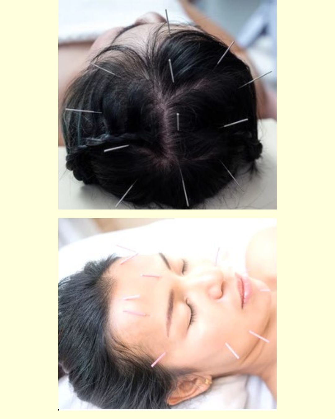 ふじおか鍼灸院 頭皮鍼（育毛）（￥8800）＋食いしばり鍼（￥4500→￥3000）のメニュー画像