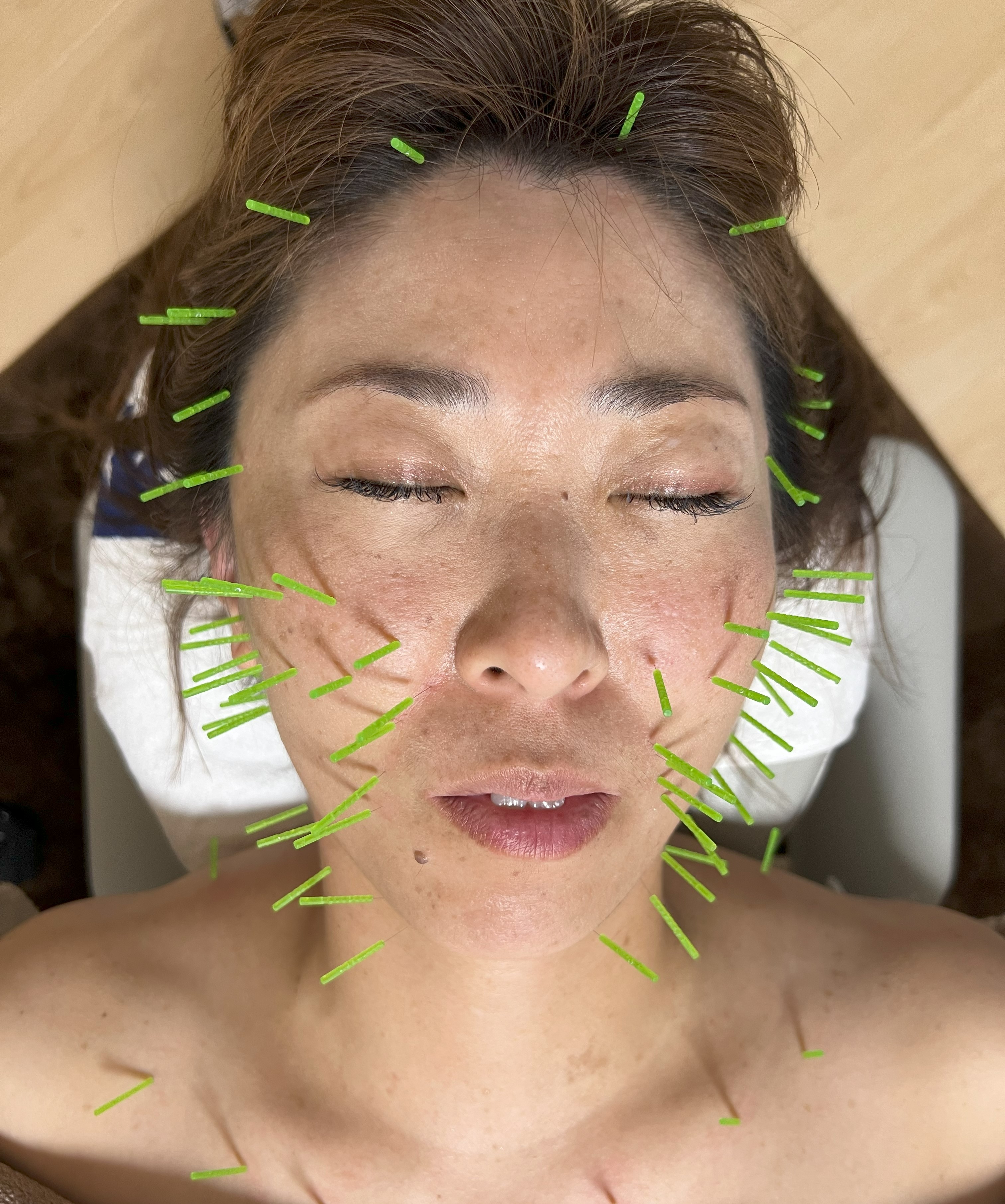 すこやか鍼灸整体院 美顔はりのメニュー画像