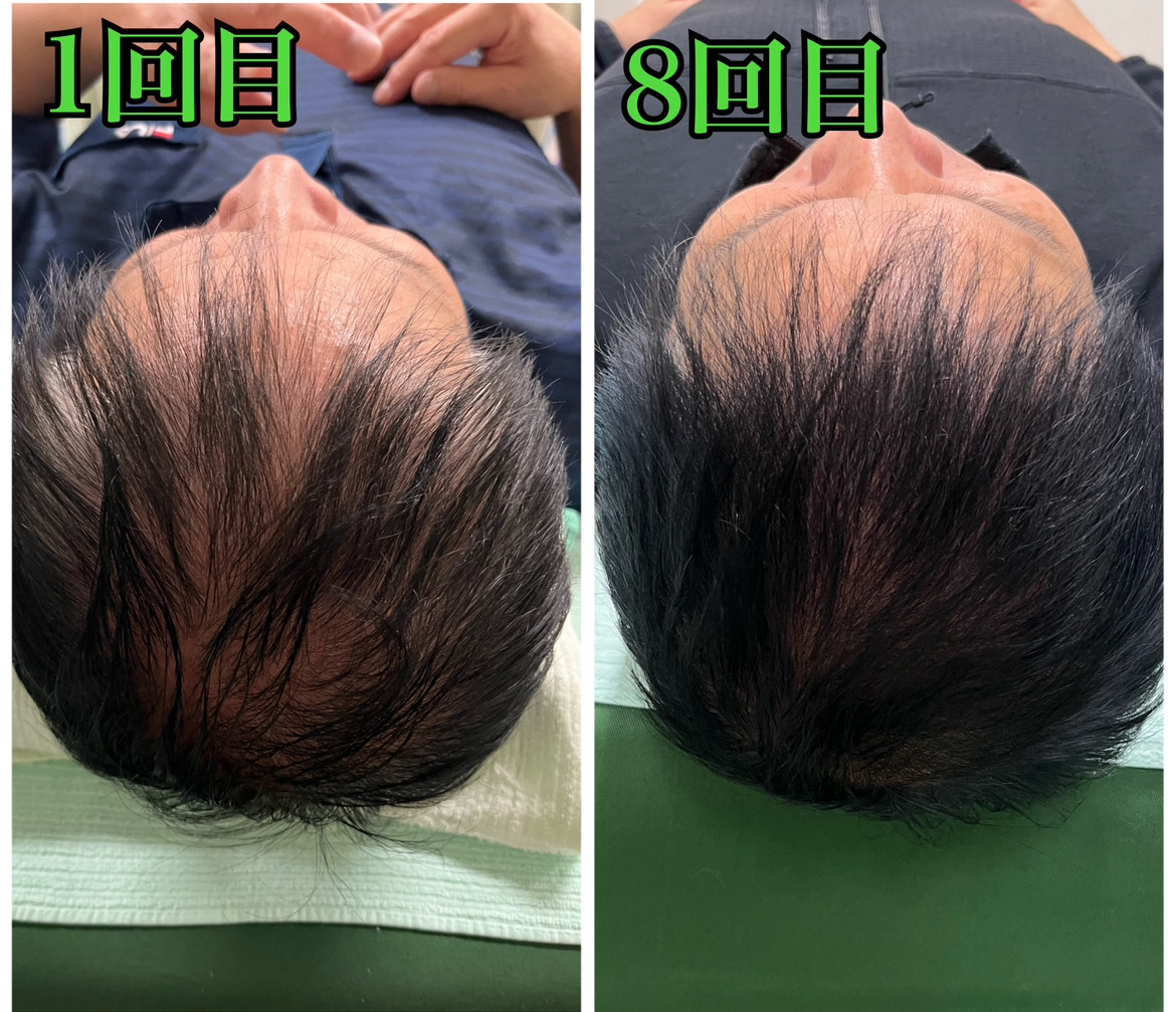 オオヤ鍼灸整骨院 姫路駅前店 ｜頭痛｜ぎっくり腰｜薄毛改善鍼 薄毛改善鍼　初診の方はこちらのメニュー画像