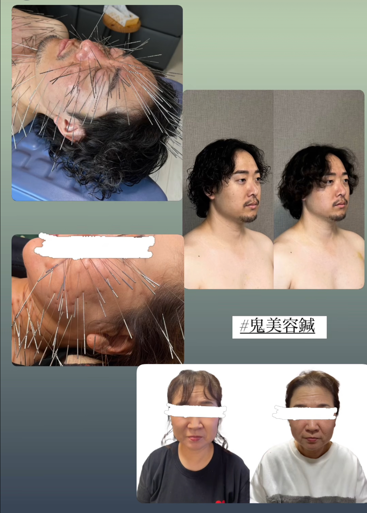 鍼処NAKAGAWA 伊吹度治療 毒だし美容鍼➕整体（伊吹度療法）のメニュー画像