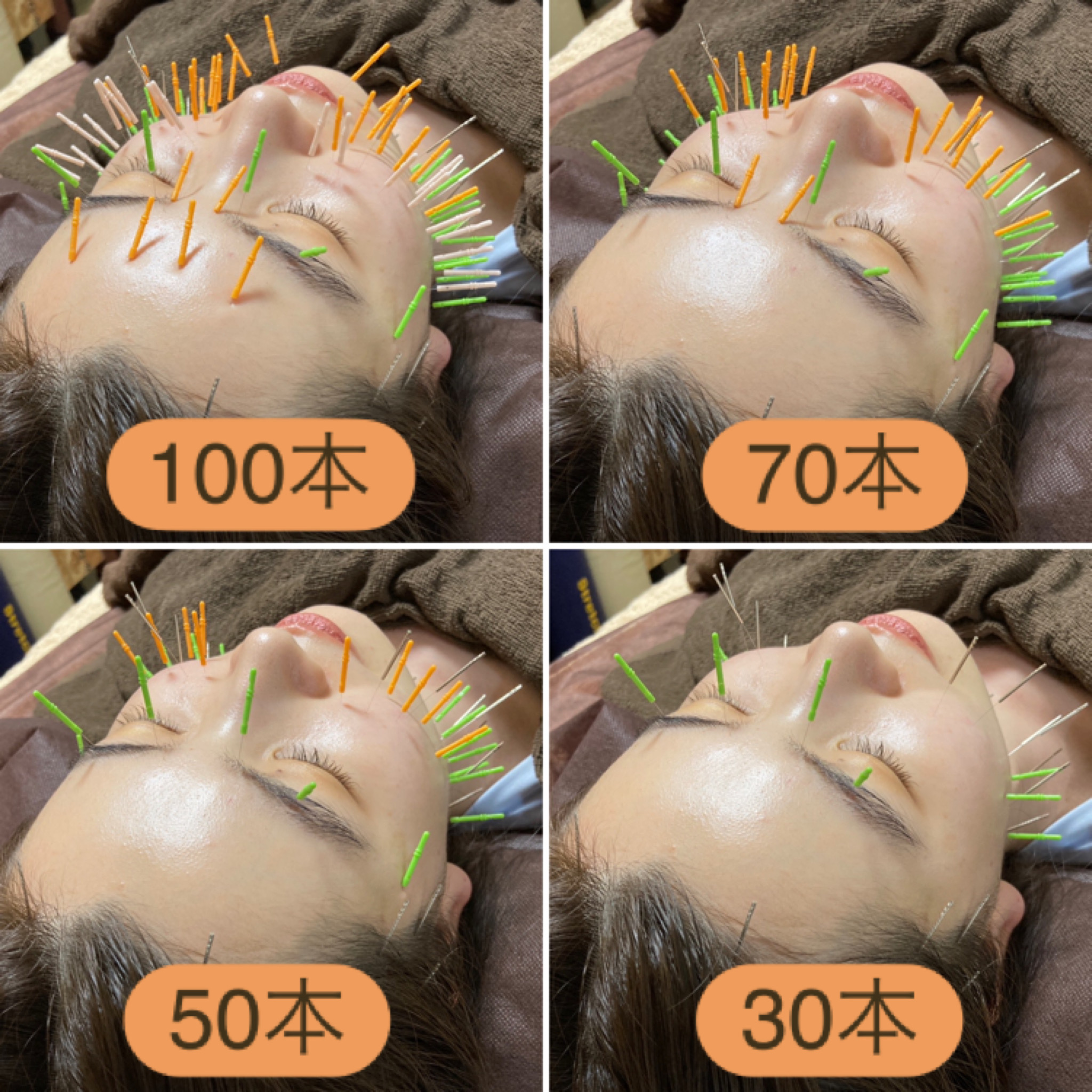 KOH鍼灸院 【60分】深層筋パルス美容鍼灸のメニュー画像