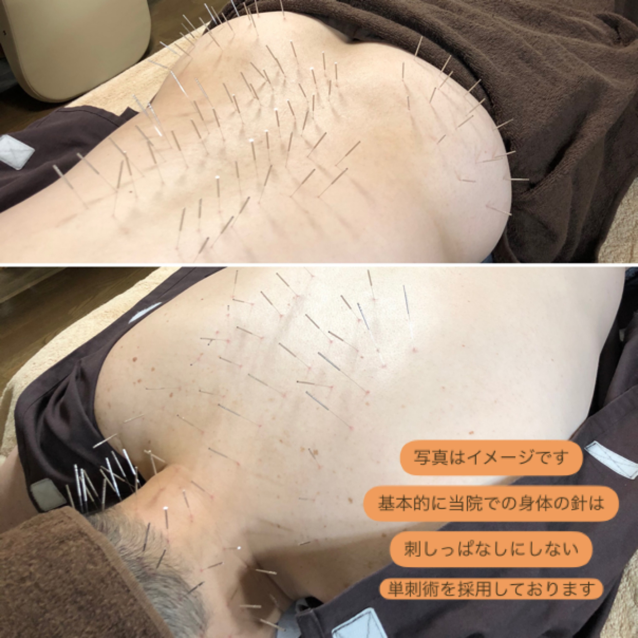 KOH鍼灸院 【頭の先から足の先まで】【120分】深層筋鍼灸整体のメニュー画像